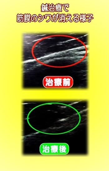 筋膜のシワが消える