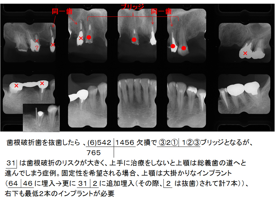 歯根破折歯を抜歯した場合の治療の見立て（予測）