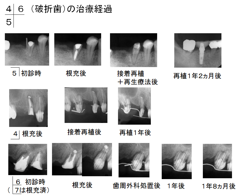 破折歯（右下７を除く３歯）の治療経過